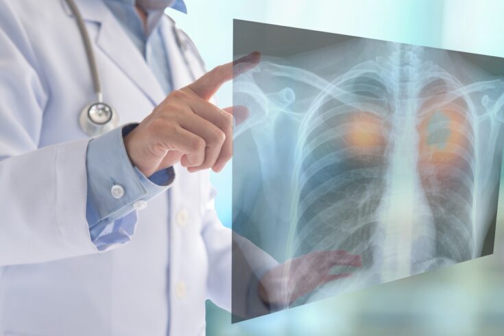 Radiology doctor examining a chest X ray of patient at hospital