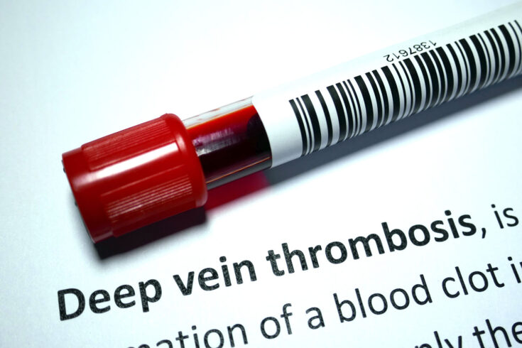 Deep vein thrombosis - blood disorder abstract.