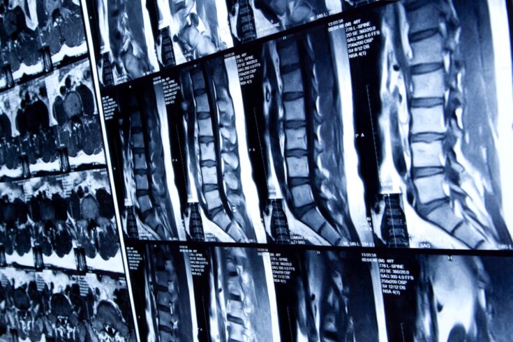 MRI scan of human lumbar spine