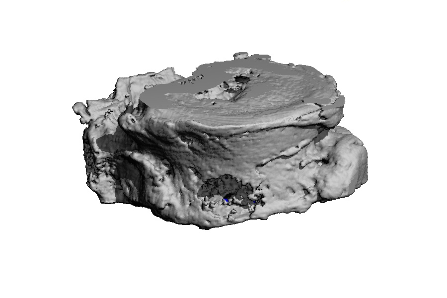A visualisation of a vertebra that has been damaged by a tumour