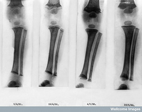 X-rays showing effect of rickets