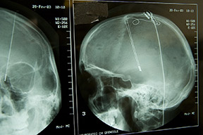 X-rays showing deep brain stimulation