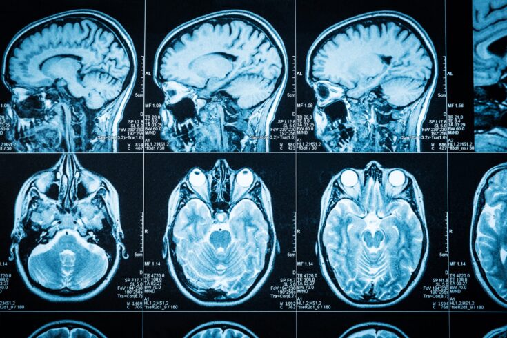 Brain scans showing multiple views