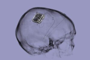 The Picostim-DyNeuMo research system, made by UK company Amber Therapeutics, is an adaptive neurostimulator seated in the skull with two electrodes placed in targeted brain circuits to sense physiological signals and provide stimulation.