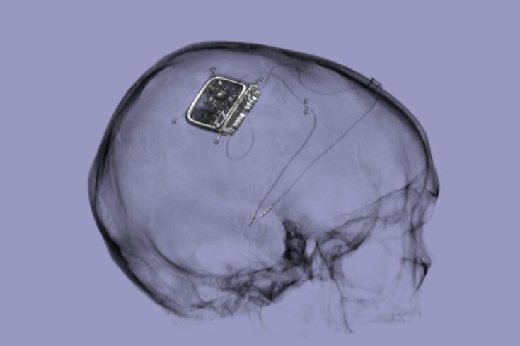 The Picostim-DyNeuMo research system, made by UK company Amber Therapeutics, is an adaptive neurostimulator seated in the skull with two electrodes placed in targeted brain circuits to sense physiological signals and provide stimulation.