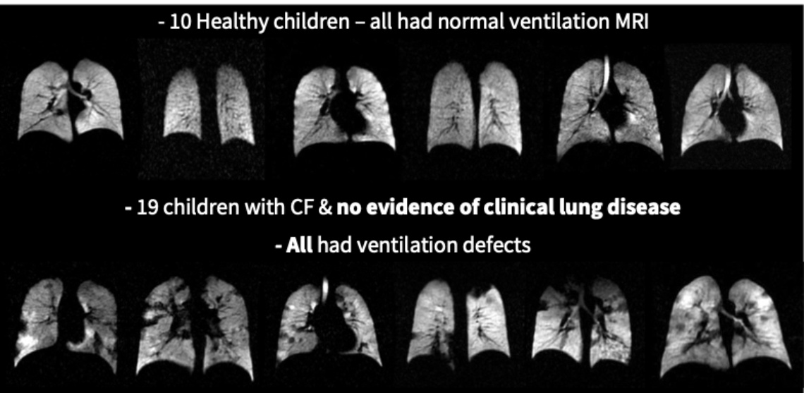 An image showing scans of healthy children’s lungs, next to scans of the lungs of children with CF and no evidence of clinical lung disease.