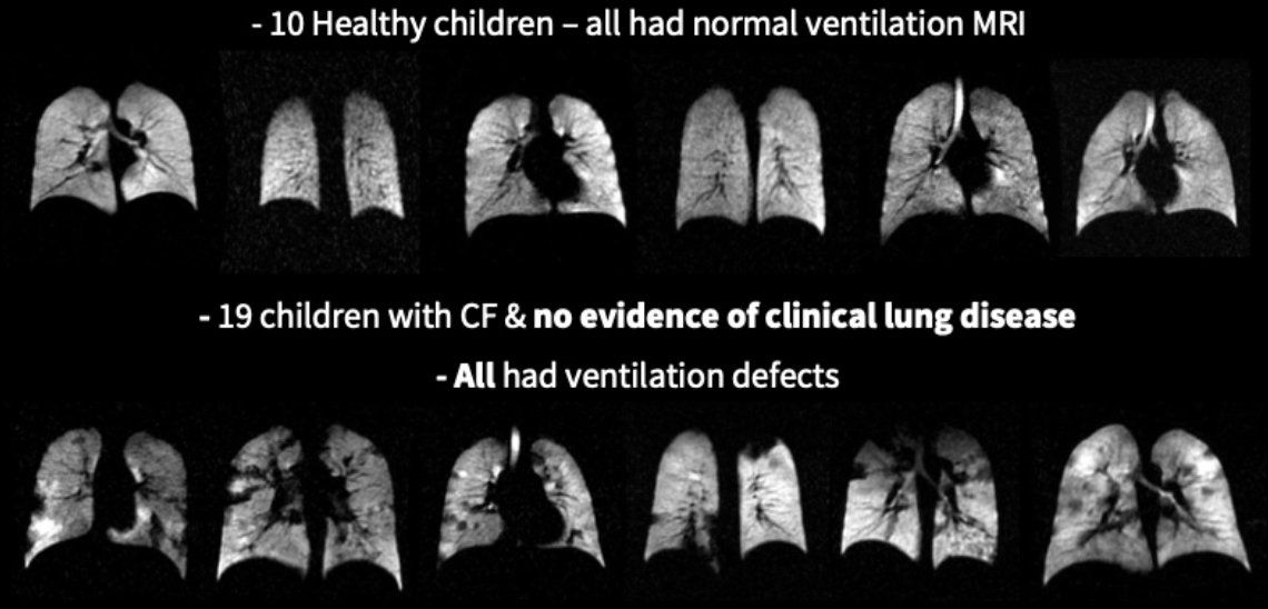 An image showing scans of healthy children’s lungs, next to scans of the lungs of children with CF and no evidence of clinical lung disease.